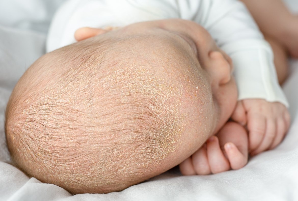 Seborrheic Dermatitis Baby