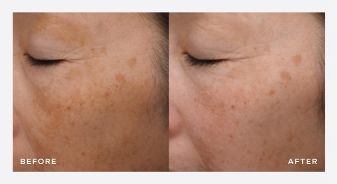 before and after - NEOSTRATA SKIN ACTIVE CELLULAR