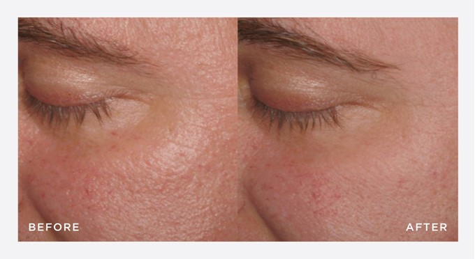 Before and after - NEOSTRATA RESURFAC GLYCOLIC FOAMING WASH