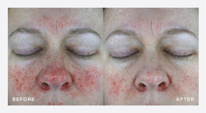 before and after - NEOSTRATA RESTORE REDNESS NEUTRALIZING SERUM