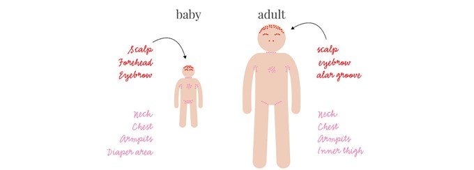 Seborrhoeic Dermatitis