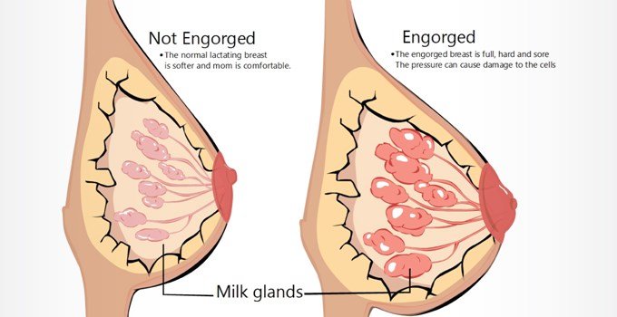 Engorgement of the breasts