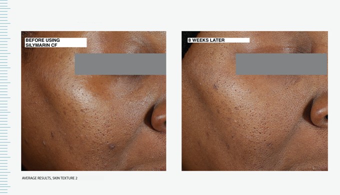 antes/depois utilização silymarin