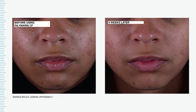 before/after use silymarin 2