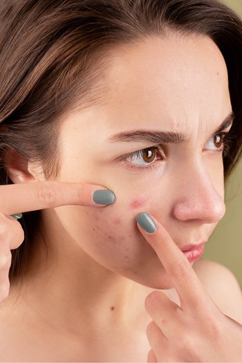 Biretix: acne treatment solution