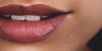 Lip herpes...and now what?