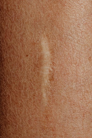 Scar Care and Prevention