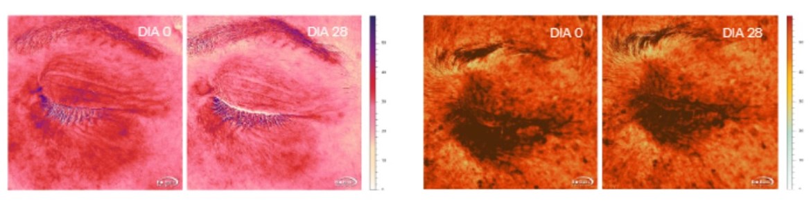 Redução do eritema e quantidade de melanina na Olheira ao final de 28 dias de tratamento