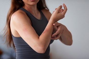 Para Além da Pele: Eczema e o Impacto na Vida Diária