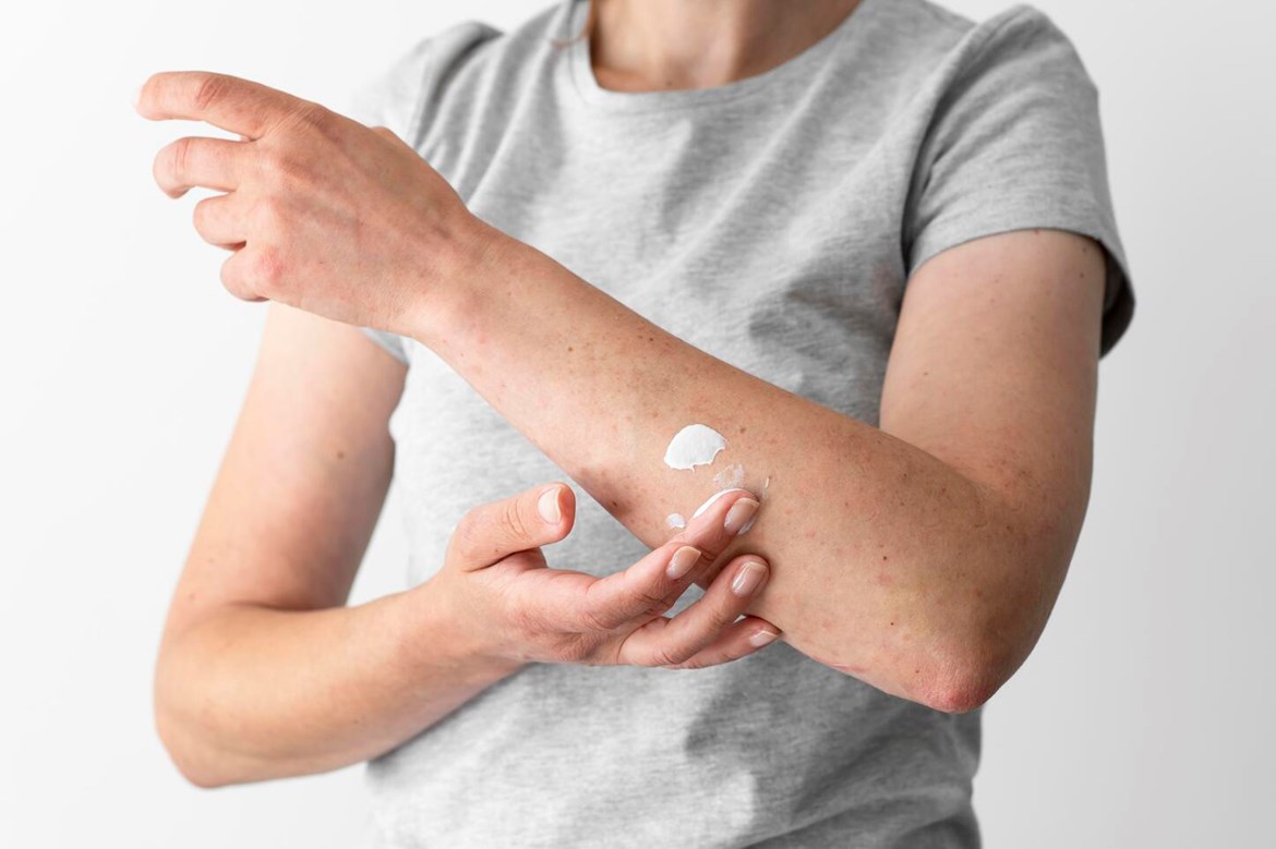 ara Além da Pele: Eczema e o Impacto na Vida Diária