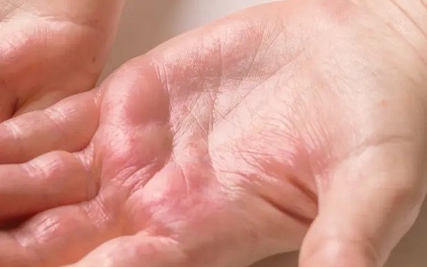 Contact Dermatitis