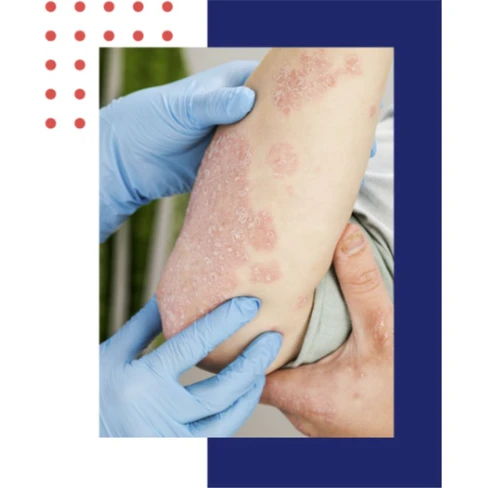 Kelo.Cell Psoris Loção Suavizante Diária para Pele com Psoríase ...